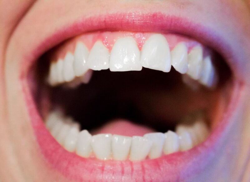 teeth whitening