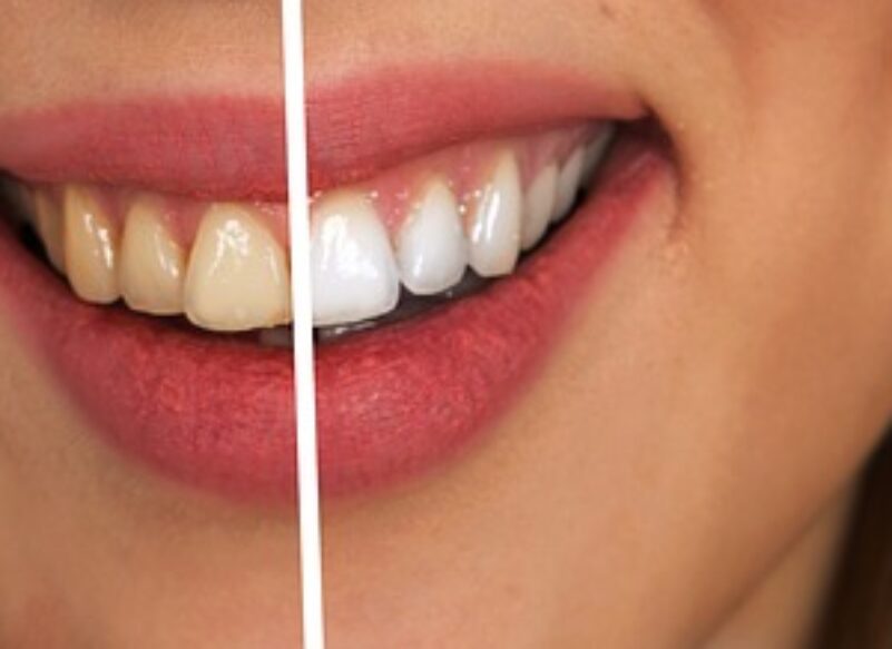blog thumb - Hove Dental Clinic