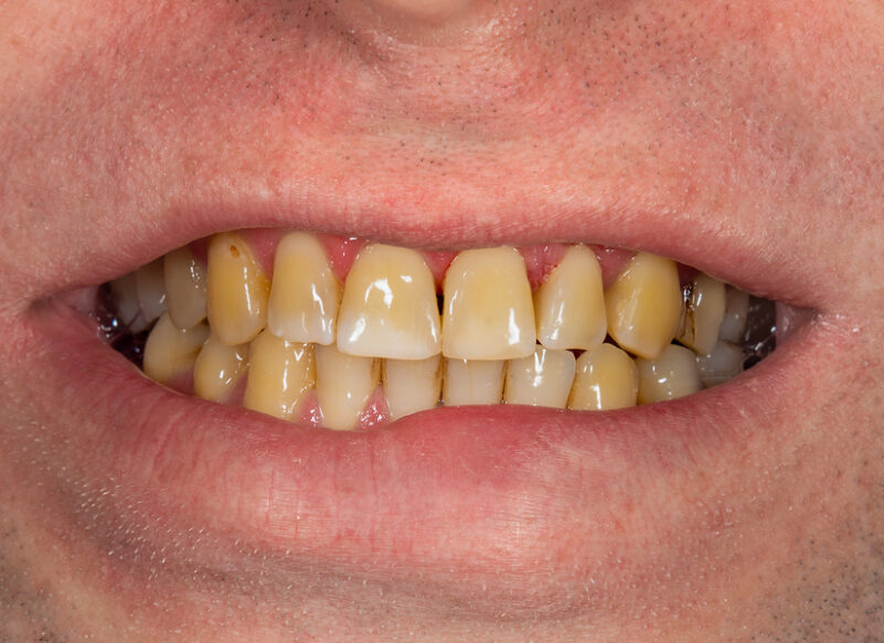 blog thumb - Hove Dental Clinic