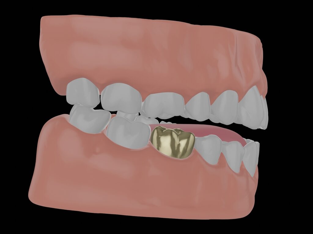 gold tooth crown