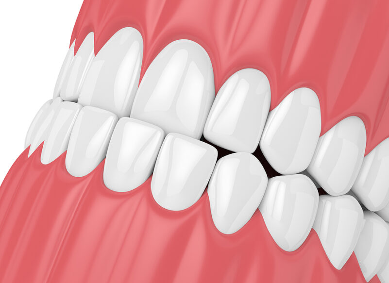 underbite