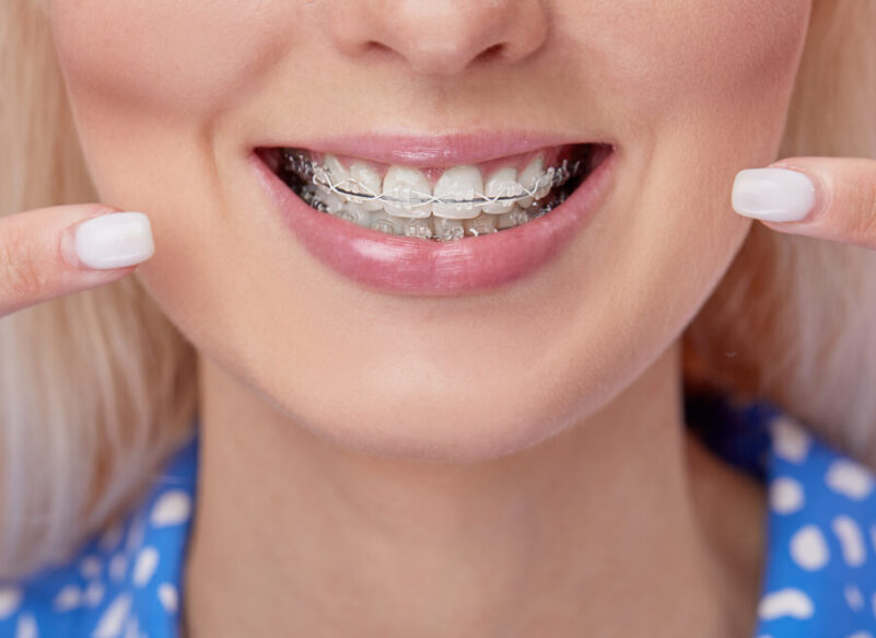 blog thumb - Hove Dental Clinic