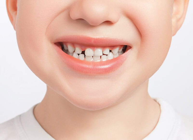 blog thumb - Hove Dental Clinic