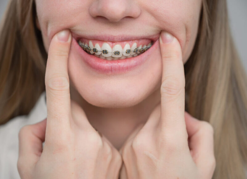 blog thumb - Hove Dental Clinic