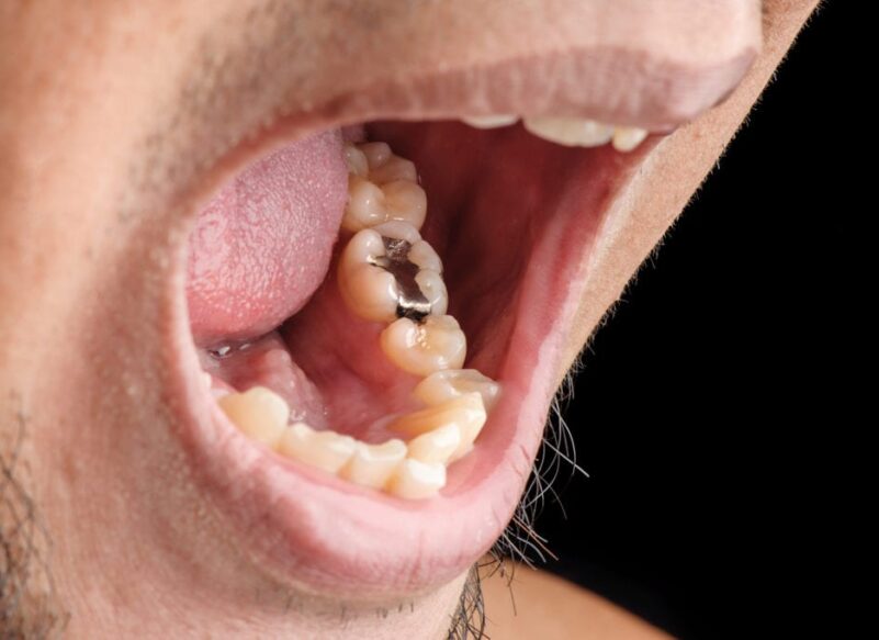 blog thumb - Hove Dental Clinic