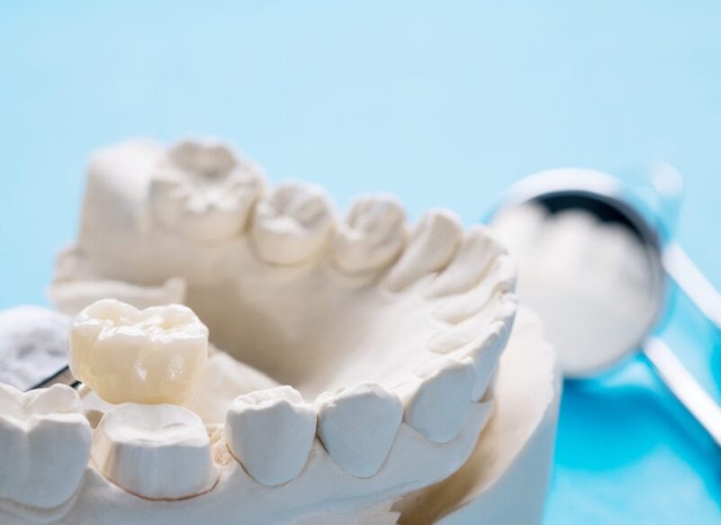 blog thumb - Hove Dental Clinic