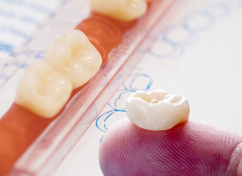 blog thumb - Hove Dental Clinic