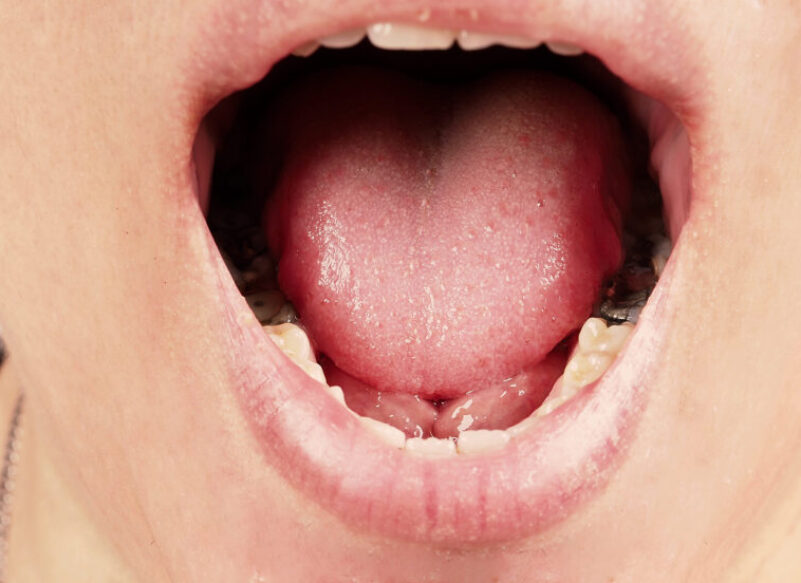 blog thumb - Hove Dental Clinic