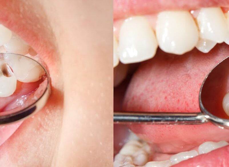 blog thumb - Hove Dental Clinic