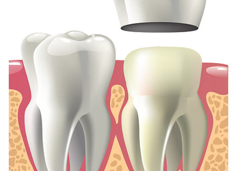 blog thumb - Hove Dental Clinic