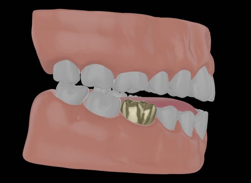 blog thumb - Hove Dental Clinic