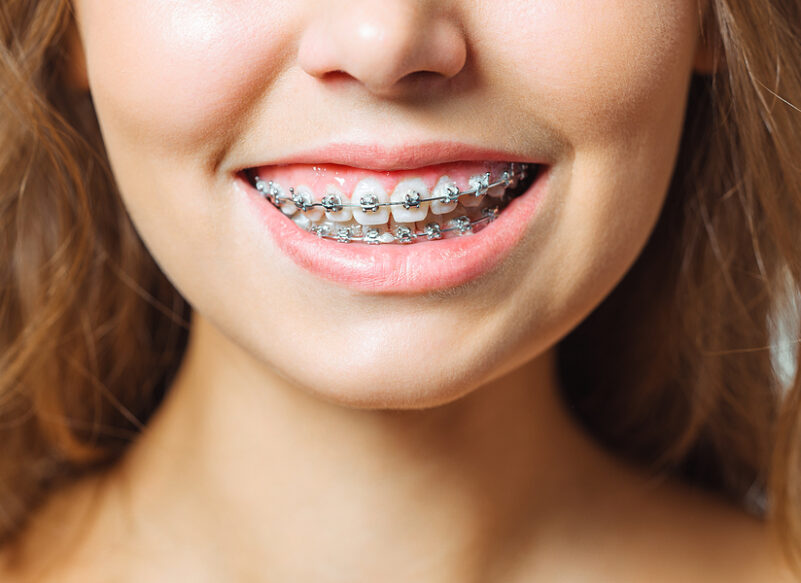 blog thumb - Hove Dental Clinic