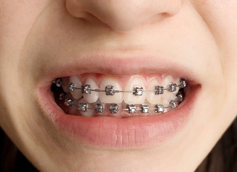 blog thumb - Hove Dental Clinic