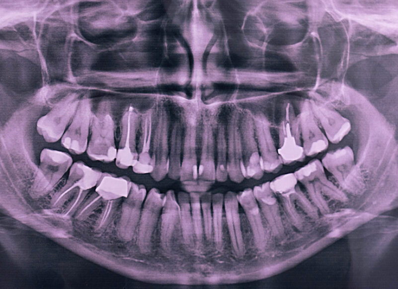 blog thumb - Hove Dental Clinic