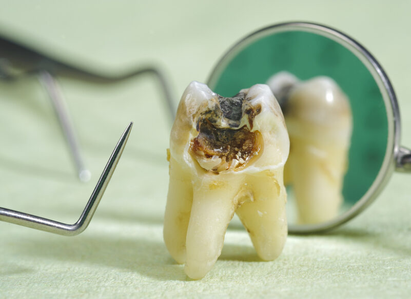 blog thumb - Hove Dental Clinic