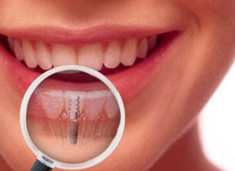 blog thumb - Hove Dental Clinic