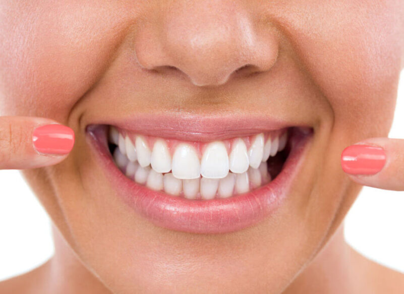 blog thumb - Hove Dental Clinic