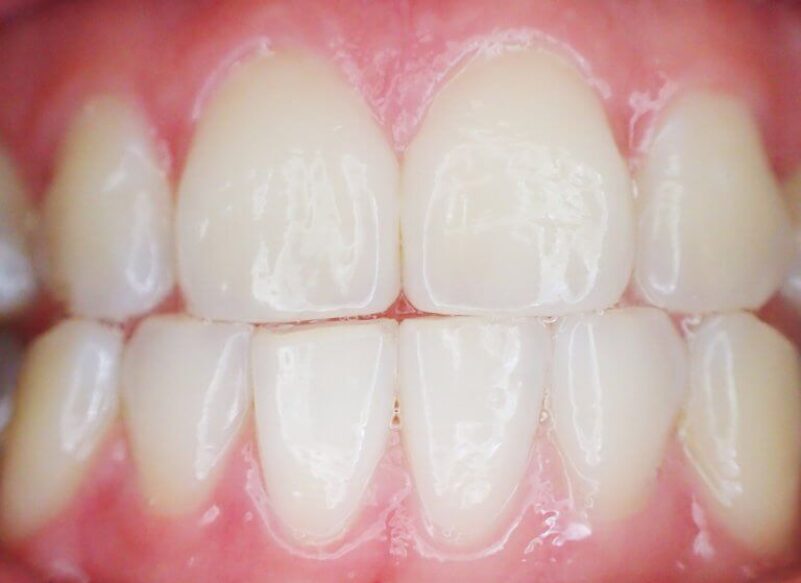 blog thumb - Hove Dental Clinic