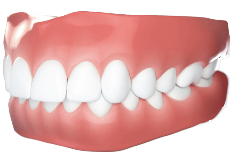 invisalign before after