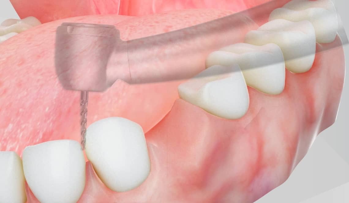 Treatment Preview Image