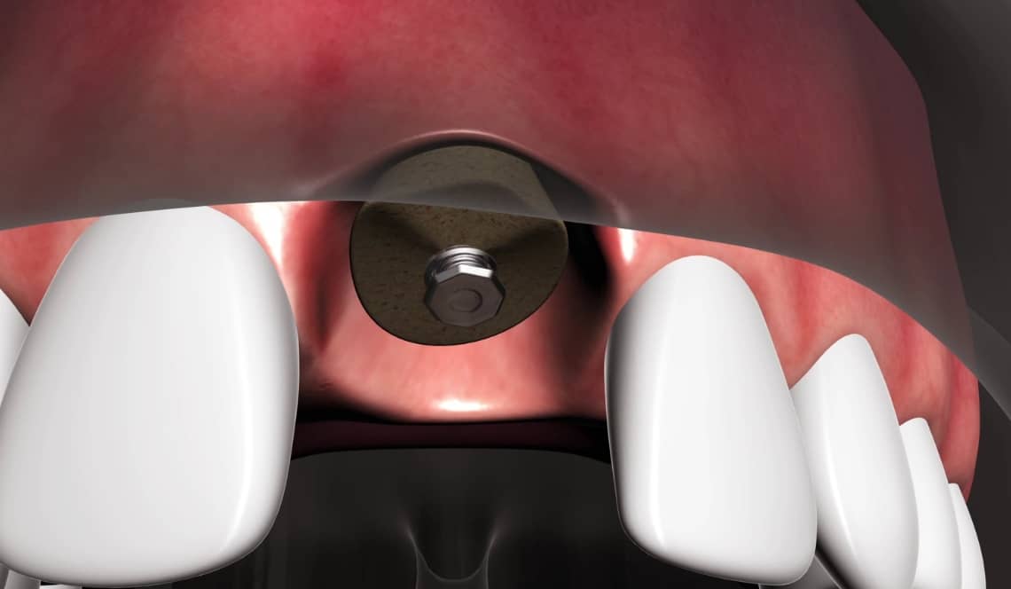 Treatment Preview Image