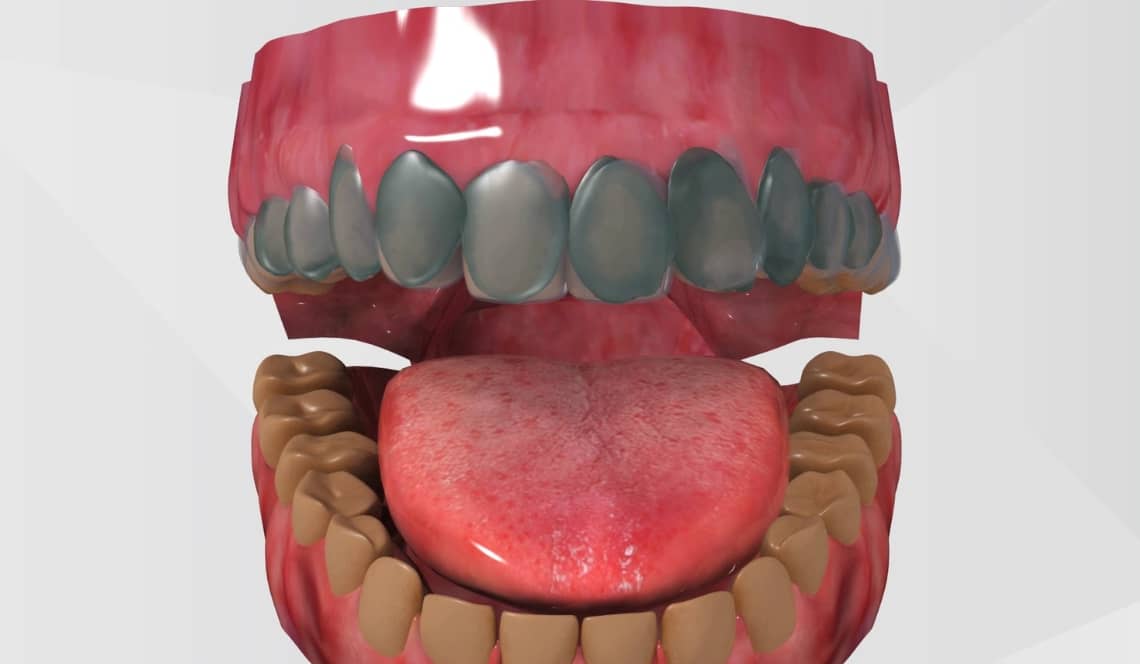 Treatment Preview Image